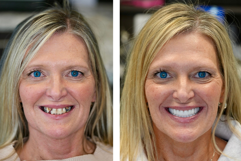 Patient before and after smile