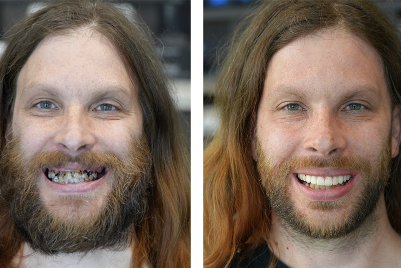 Patient before and after smile
