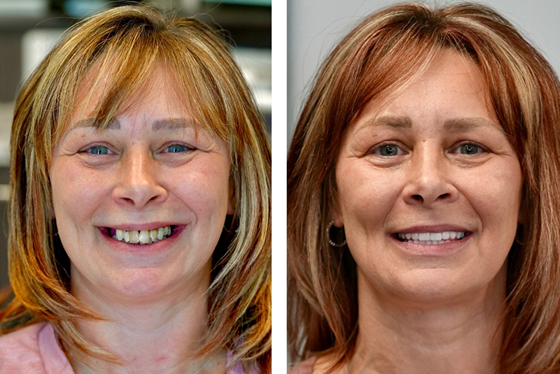 Patient before and after smile