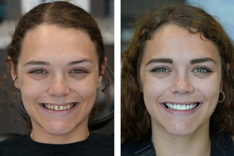 Patient before and after smile